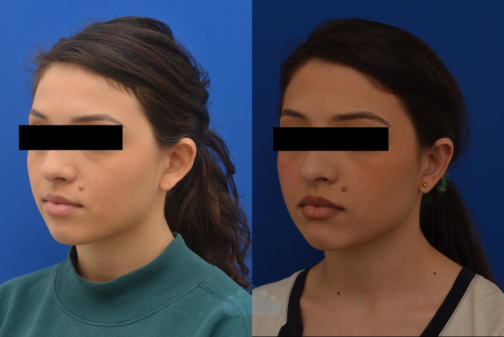 Before & After Otoplasty Case 7 Left Oblique View in Charlotte, NC