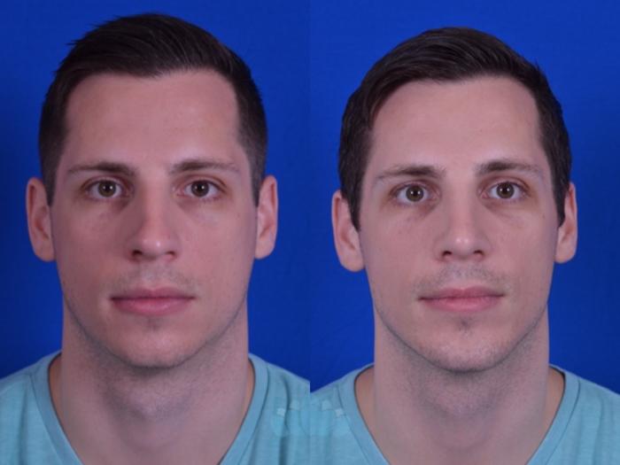 Before & After Rhinoplasty Case 105 Front View in Charlotte, NC