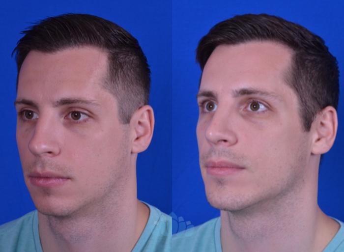 Before & After Rhinoplasty Case 105 Left Oblique View in Charlotte, NC