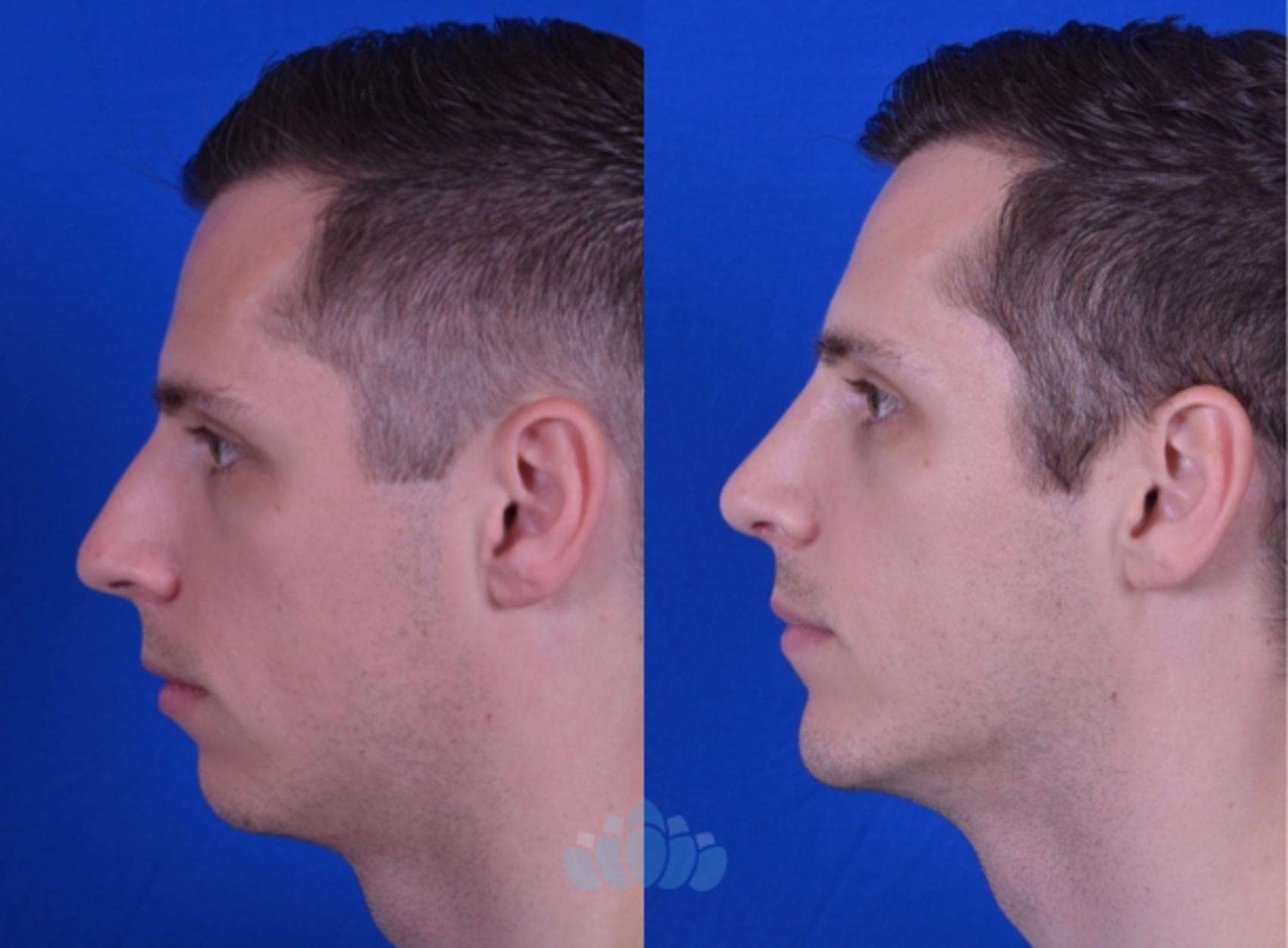 Before & After Rhinoplasty Case 105 Left Side View in Charlotte, NC