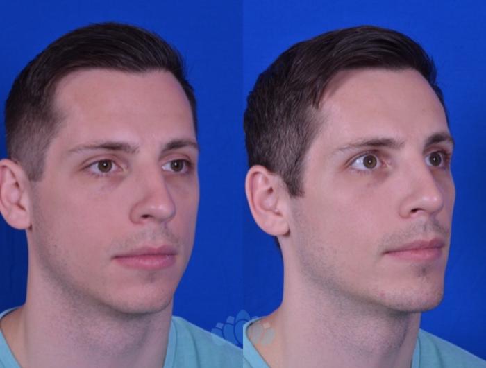 Before & After Rhinoplasty Case 105 Right Oblique View in Charlotte, NC