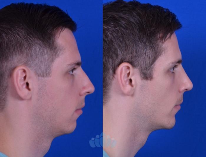 Before & After Rhinoplasty Case 105 Right Side View in Charlotte, NC