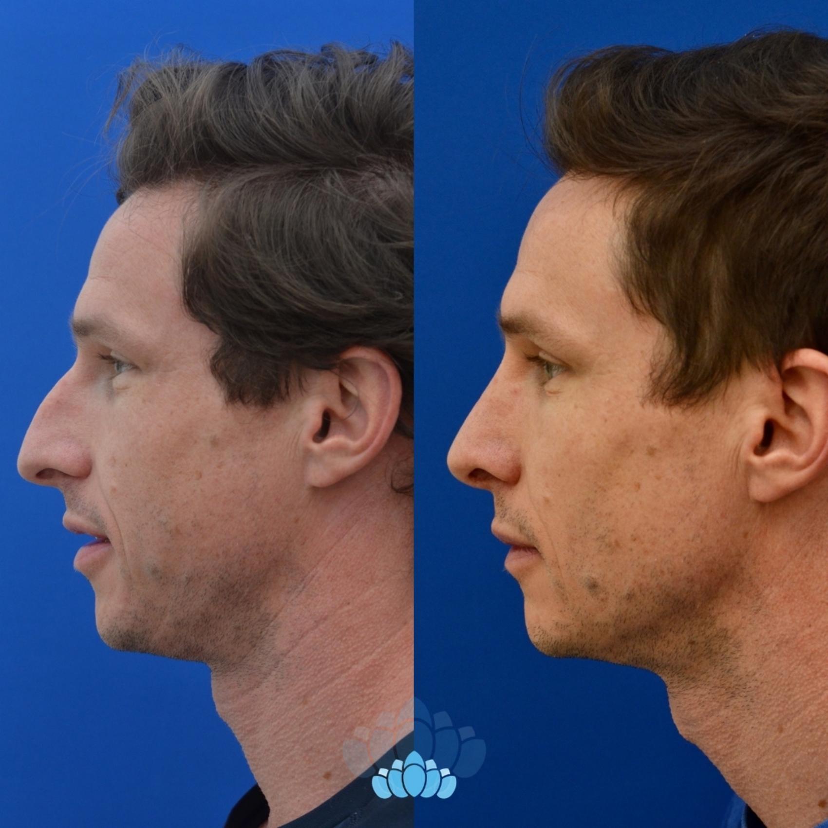 Before & After Rhinoplasty Case 14 Left Side View in Charlotte, NC