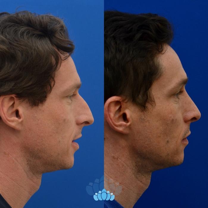 Before & After Rhinoplasty Case 14 Right Side View in Charlotte, NC