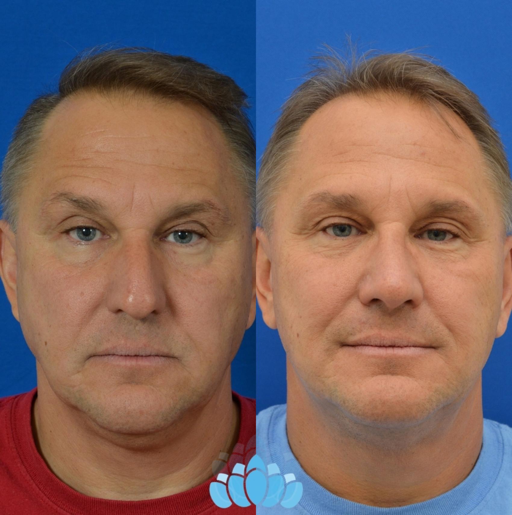 Before & After Rhinoplasty Case 15 Front View in Charlotte, NC