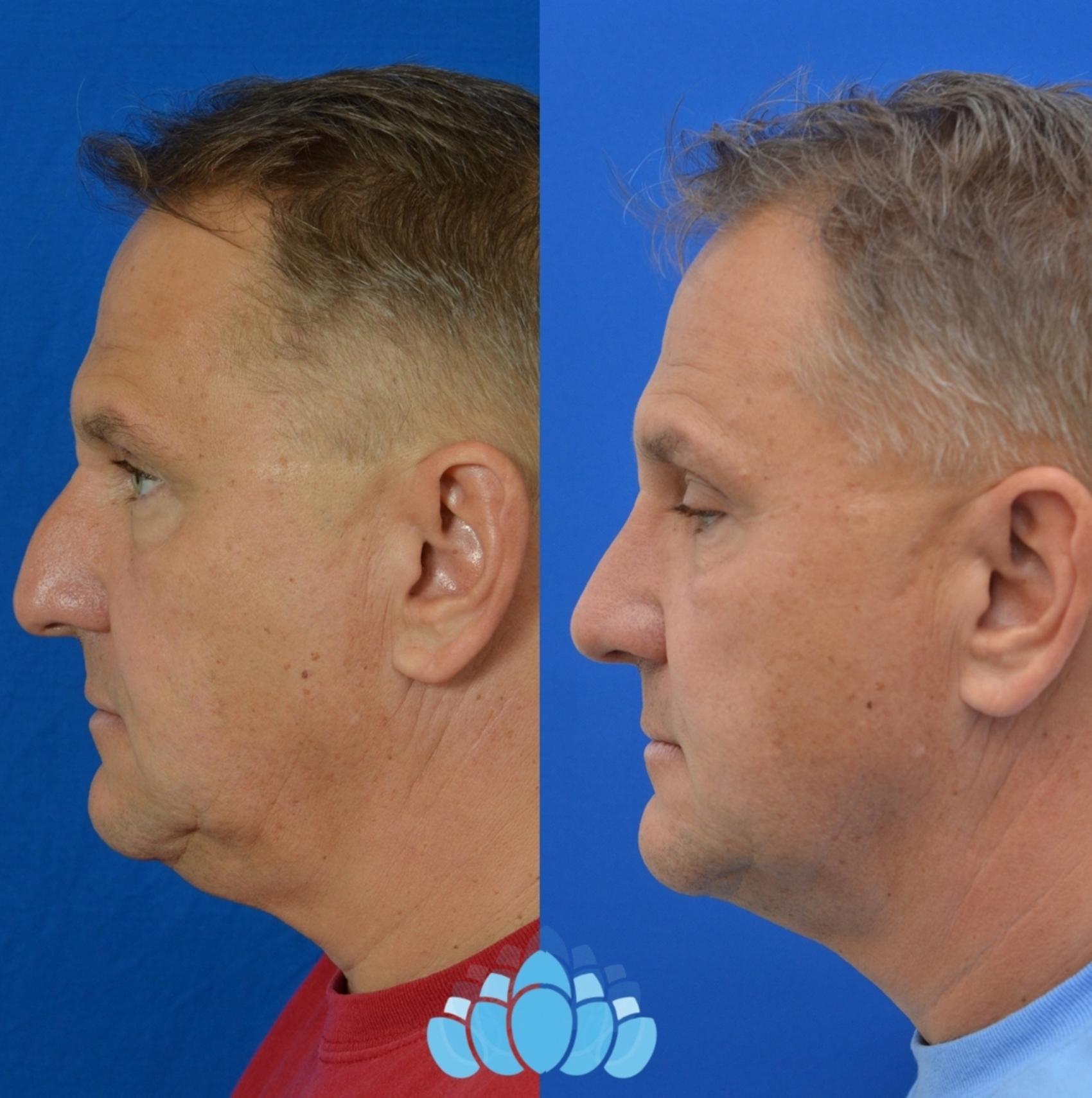 Before & After Rhinoplasty Case 15 Right Side View in Charlotte, NC