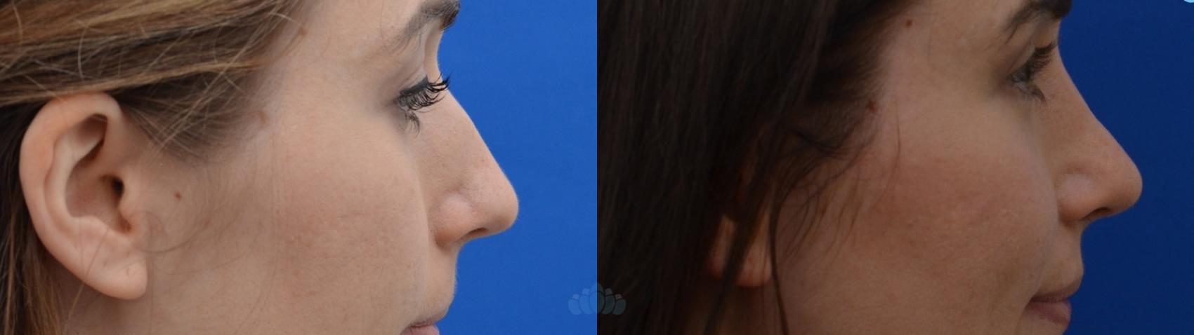 Before & After Rhinoplasty Case 16 Left Side View in Charlotte, NC