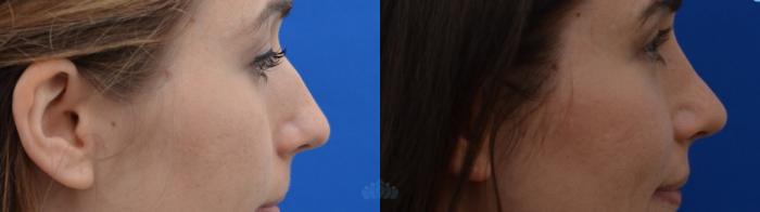 Before & After Rhinoplasty Case 16 Left Side View in Charlotte, NC