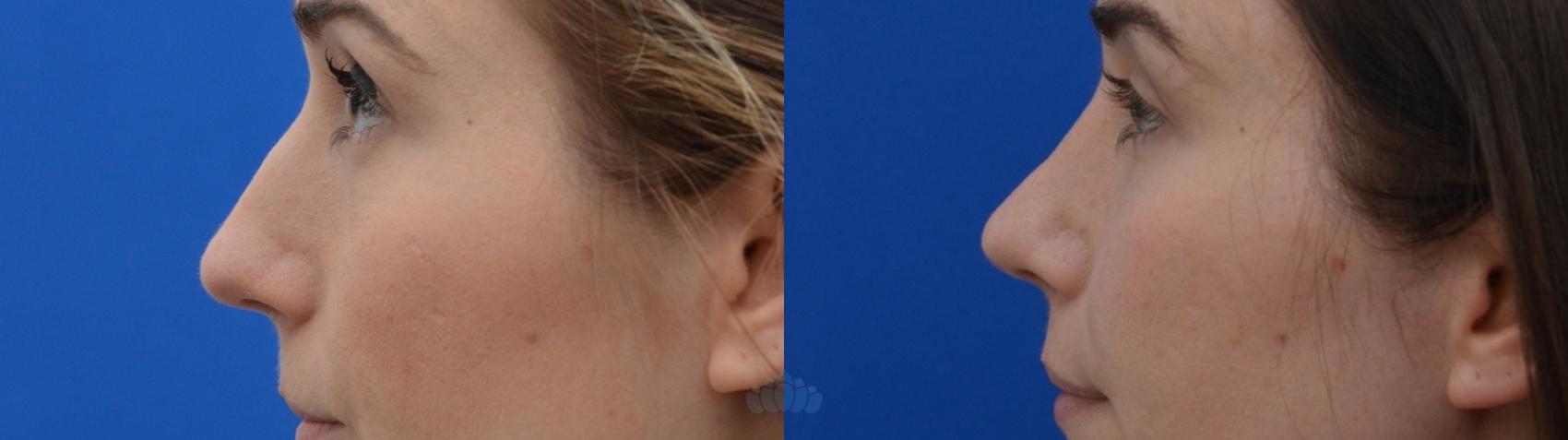 Before & After Rhinoplasty Case 16 Right Side View in Charlotte, NC
