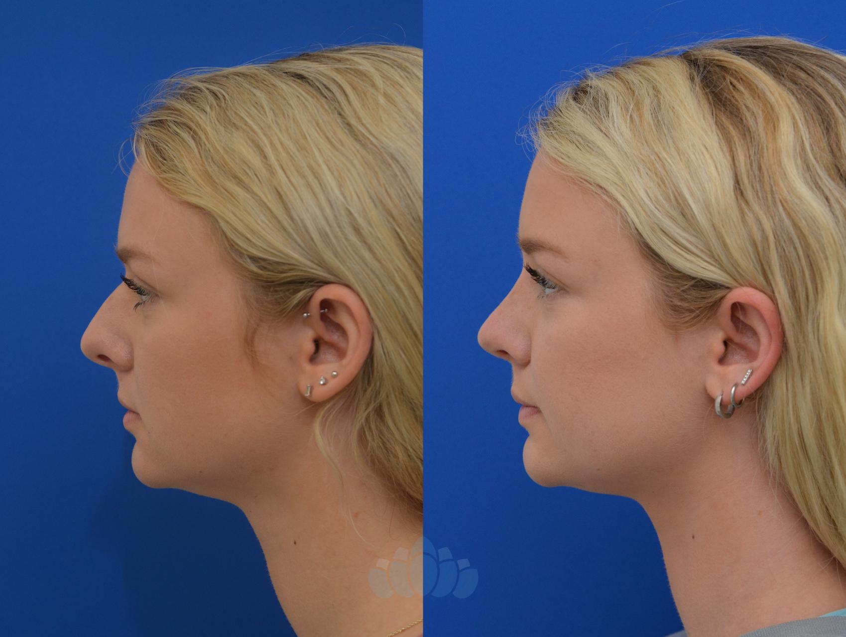 Before & After Rhinoplasty Case 2 Left Side View in Charlotte, NC