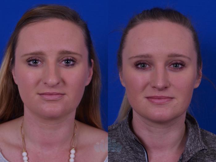 Before & After Rhinoplasty Case 49 Front View in Charlotte, NC