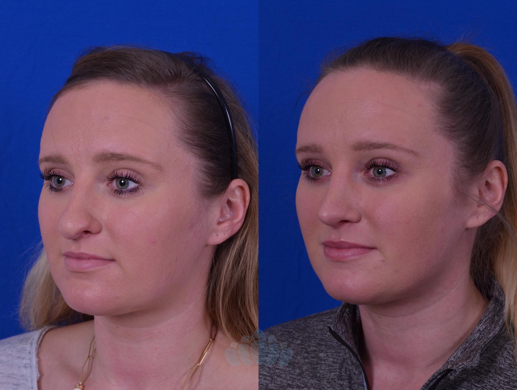 Before & After Rhinoplasty Case 49 Left Oblique View in Charlotte, NC