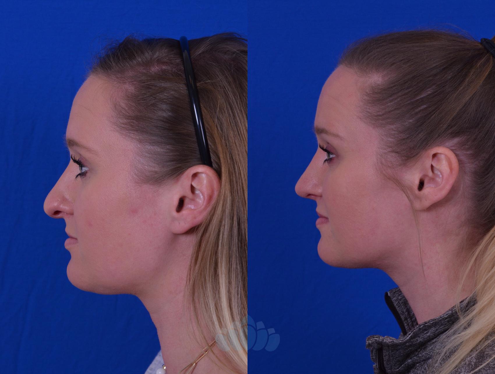 Before & After Rhinoplasty Case 49 Left Side View in Charlotte, NC