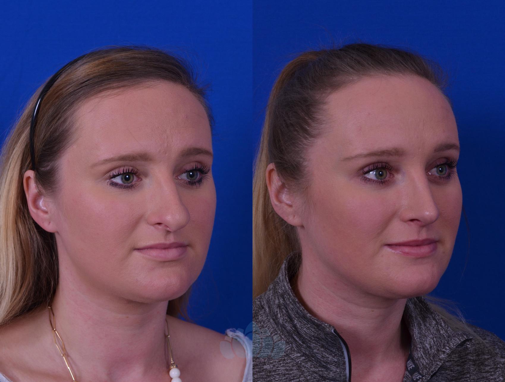 Before & After Rhinoplasty Case 49 Right Oblique View in Charlotte, NC