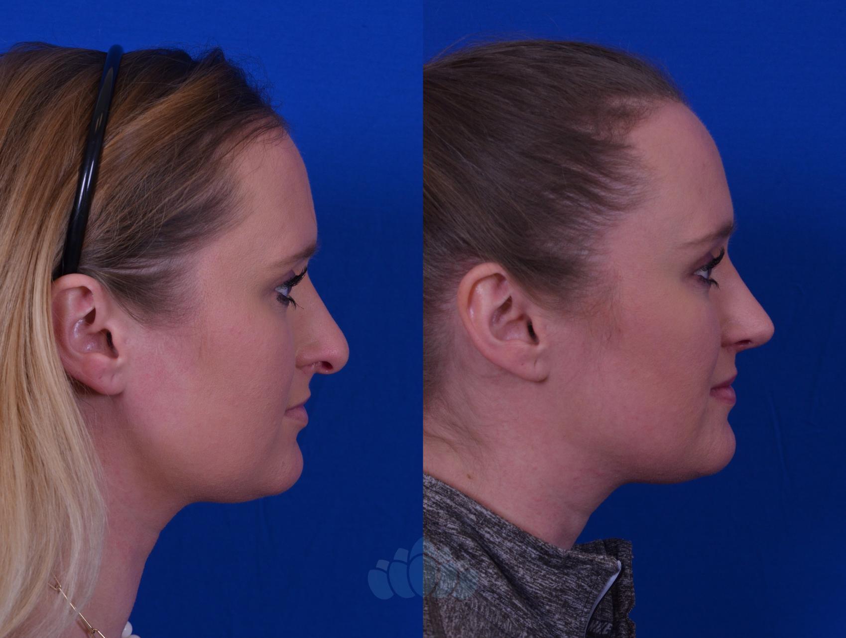 Before & After Rhinoplasty Case 49 Right Side View in Charlotte, NC