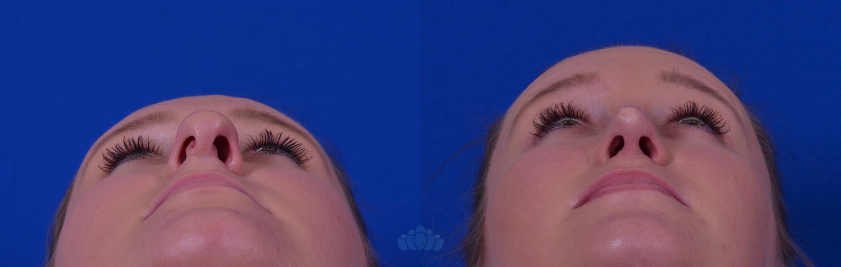 Before & After Rhinoplasty Case 49 Under Side View in Charlotte, NC