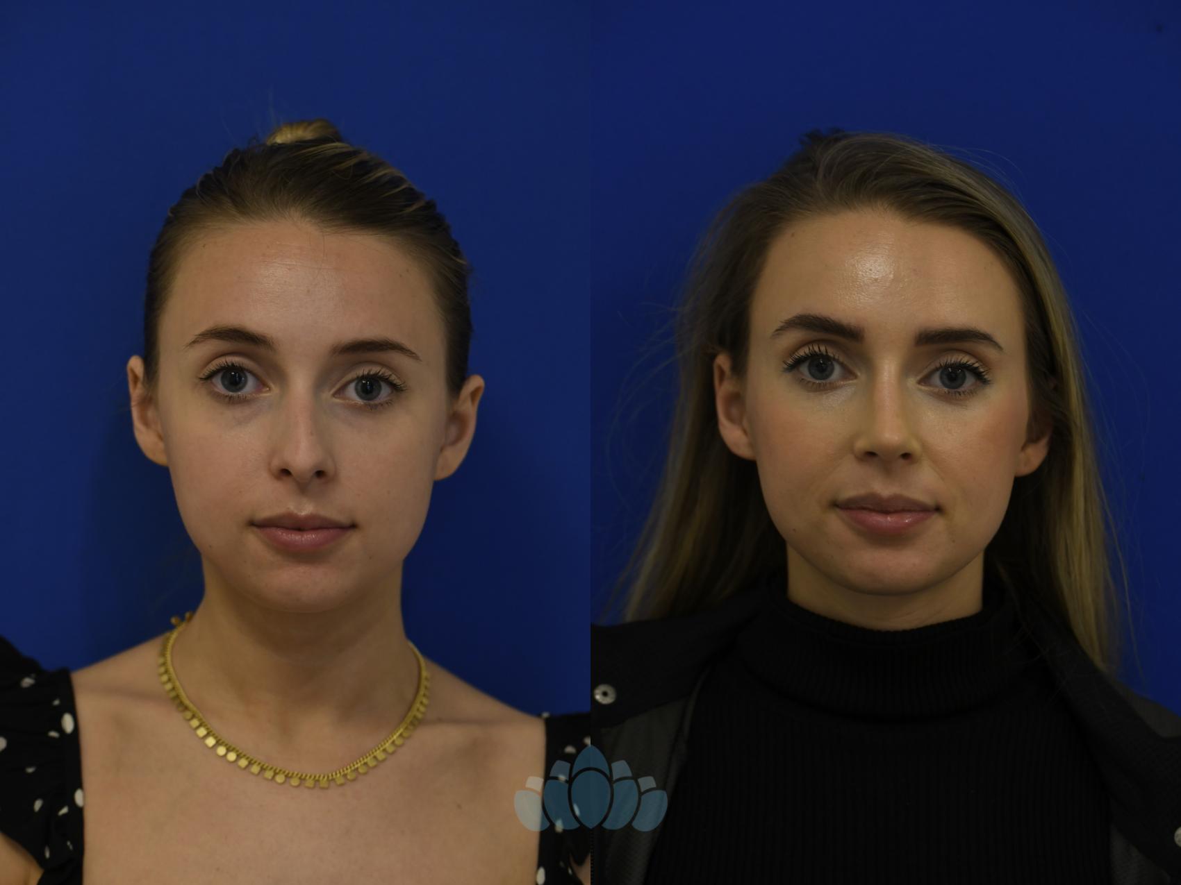 Before & After Rhinoplasty Case 98 Front View in Charlotte, NC