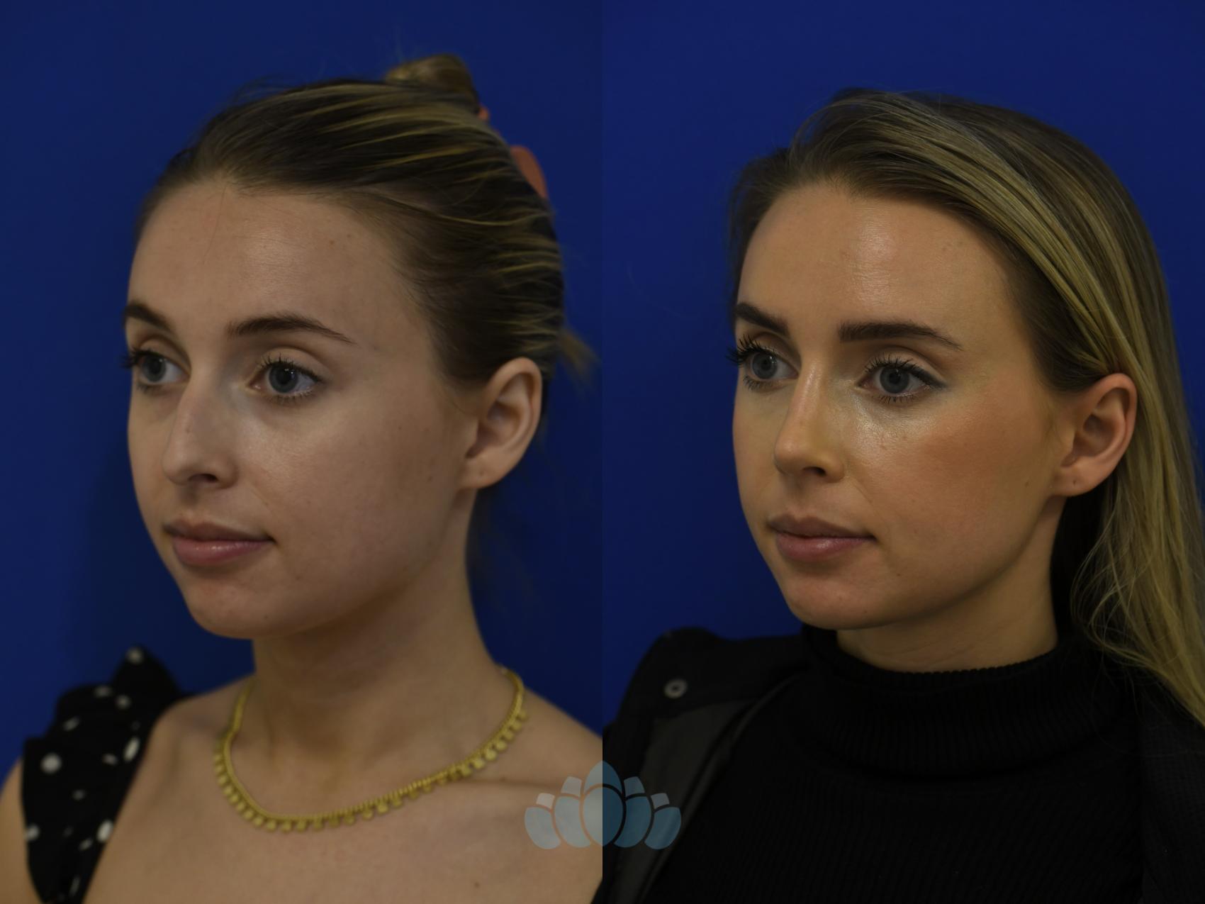 Before & After Rhinoplasty Case 98 Left Oblique View in Charlotte, NC