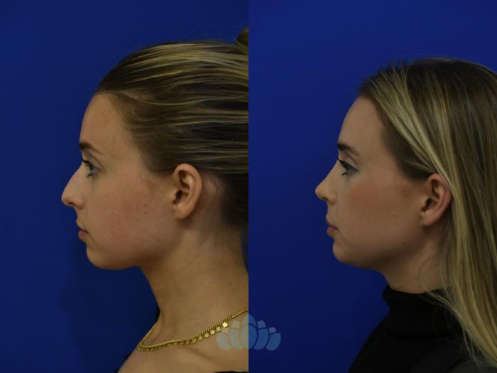 Before & After Rhinoplasty Case 98 Left Side View in Charlotte, NC