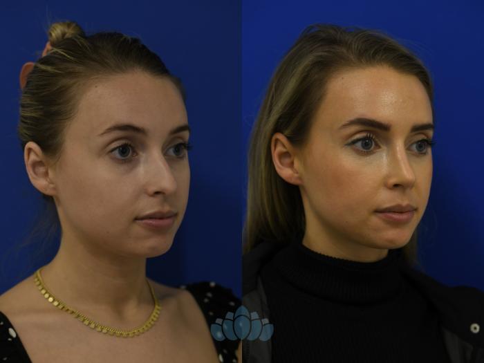 Before & After Rhinoplasty Case 98 Right Oblique View in Charlotte, NC