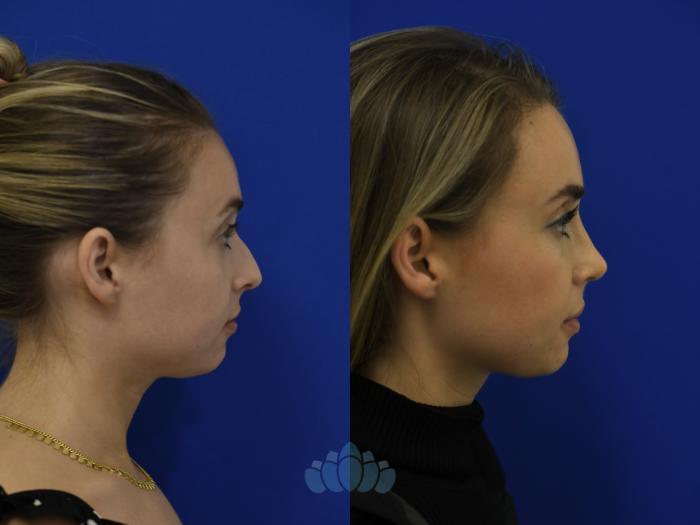 Before & After Rhinoplasty Case 98 Right Side View in Charlotte, NC