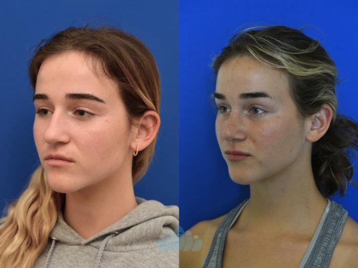 Before & After Rhinoplasty Case 99 Left Oblique View in Charlotte, NC