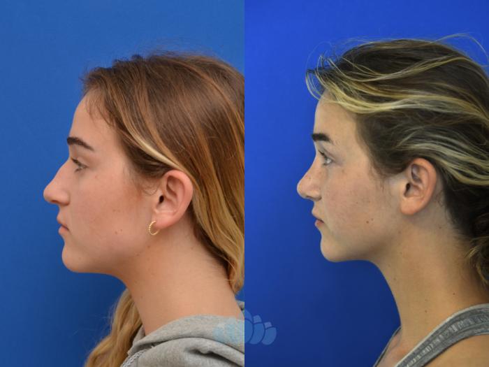 Before & After Rhinoplasty Case 99 Left Side View in Charlotte, NC