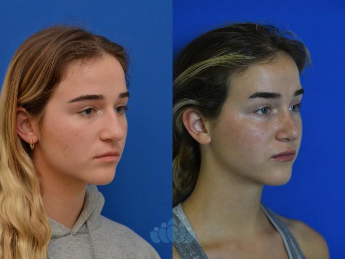 Before & After Rhinoplasty Case 99 Right Oblique View in Charlotte, NC