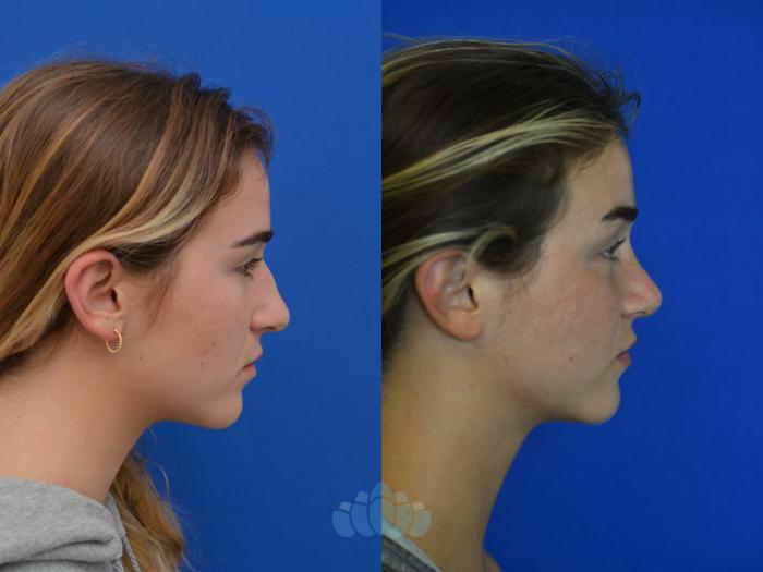 Before & After Rhinoplasty Case 99 Right Side View in Charlotte, NC