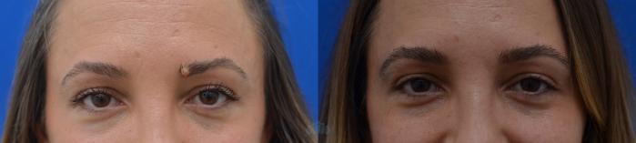 Before & After Scar Revision & Mole Removal Case 22 Front View in Charlotte, NC