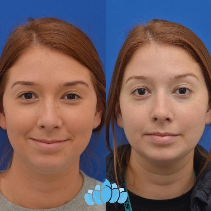Before & After Scar Revision & Mole Removal Case 24 Front View in Charlotte, NC