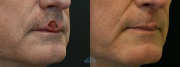 Before & After Mohs & Skin Cancer Surgery Case 122 Right Oblique View in Charlotte, NC