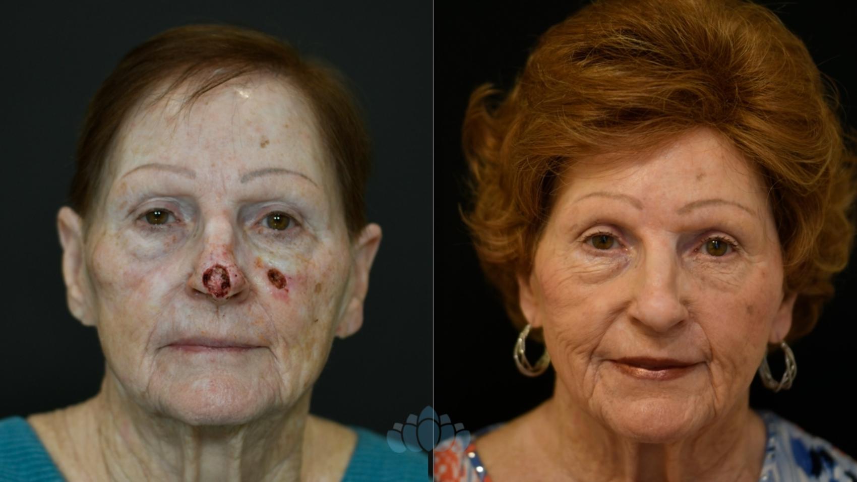 Before & After Skin Cancer Reconstruction after Mohs Surgery Case 123 Front View in Charlotte, NC