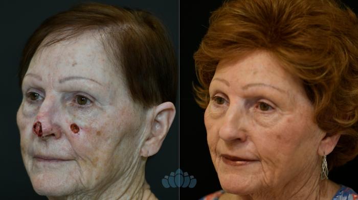 Before & After Skin Cancer Reconstruction after Mohs Surgery Case 123 Left Oblique View in Charlotte, NC