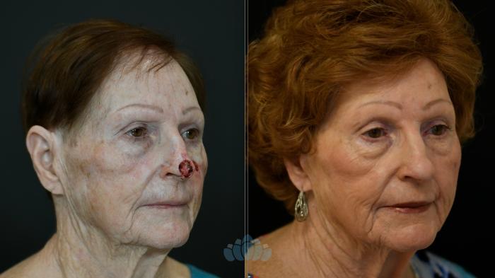 Before & After Skin Cancer Reconstruction after Mohs Surgery Case 123 Right Oblique View in Charlotte, NC