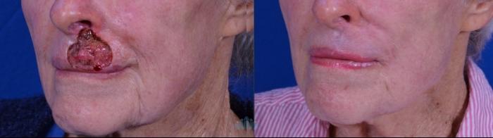 Before & After Skin Cancer Reconstruction after Mohs Surgery Case 21 Left Oblique View in Charlotte, NC