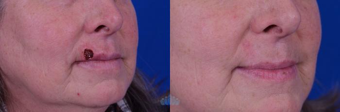 Before & After Skin Cancer Reconstruction after Mohs Surgery Case 3 Right Oblique View in Charlotte, NC
