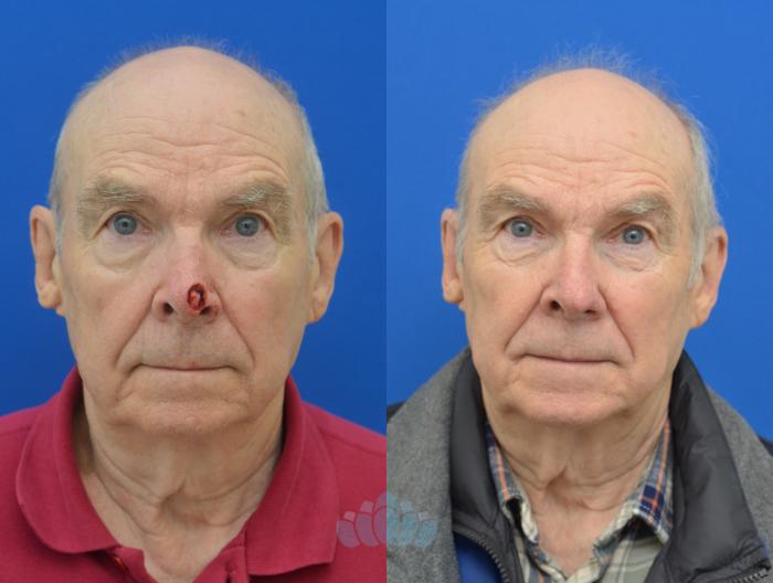 Before & After Skin Cancer Reconstruction after Mohs Surgery Case 4 Front View in Charlotte, NC