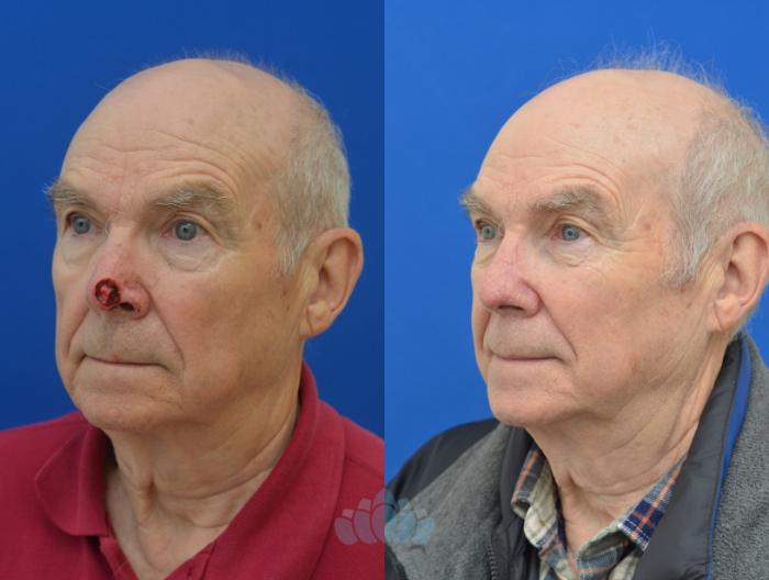 Before & After Skin Cancer Reconstruction after Mohs Surgery Case 4 Left Oblique View in Charlotte, NC