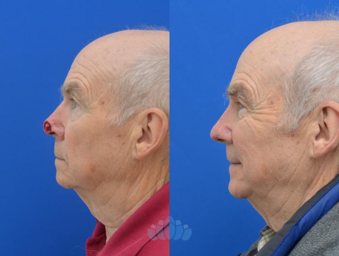 Before & After Skin Cancer Reconstruction after Mohs Surgery Case 4 Left Side View in Charlotte, NC