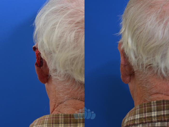 Before & After Skin Cancer Reconstruction after Mohs Surgery Case 5 Back View in Charlotte, NC