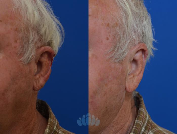 Before & After Skin Cancer Reconstruction after Mohs Surgery Case 5 Left Oblique View in Charlotte, NC